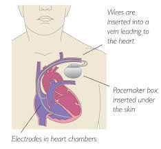 The pacemaker is an electronic biomedical device that can regulate the human heartbeat when its first developed in the 1950s, the pacemaker has undergone various design changes and has found. Pacemakers Chest Heart Stroke Scotland