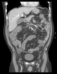 Image result for Neutropenic Colitis