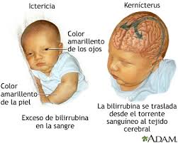 Image result for Kernicterus