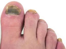 Skin between my toes is green download here free healthcaremagic app to ask a doctor. Another Downside Of Weight Gain Toenail Fungus