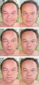 What you can do to reduce synkinesis by yourself