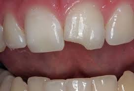 Teeth Grinding Treatment Mouth Guards And How To Stop