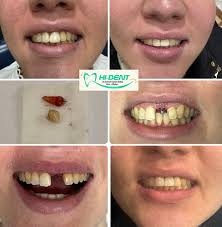 Hi Dent Dr. Ashraf Kamel (@hi.dent.egy) · Instagram 照片和视频