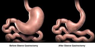 Slowly But Surely Sleeve Gastrectomy Vertical Sleeve Gastrectomy Sleeve Surgery