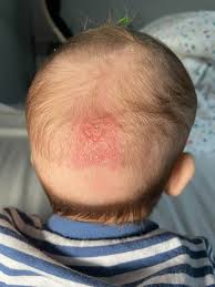 Image result for Cradle Cap
