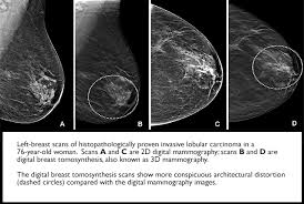 Image result for Mammogram Interpretation