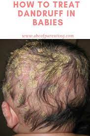 Not sure the difference between the two? How To Treat Dandruff In Babies Dandruff Baby Dandruff How To Treat Dandruff