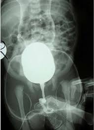 Image result for Voiding Cystourethrogram