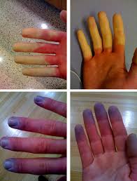 Pronunciation of raynaud with 2 audio pronunciations, 1 meaning, 6 translations, 1 sentence and more for raynaud. Talk Raynaud Syndrome Wikipedia