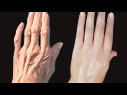 Maybe you would like to learn more about one of these? How To Remove Wrinkles On Your Hands Clear The Hand Roughness And Dryness Youtube Wrinkle Remover Wrinkles Hands Wrinkles