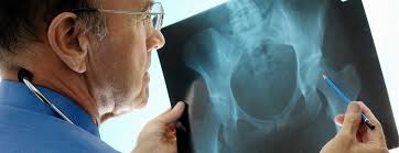 Nov 16, 2020 · getting enough calcium and vitamin d can help to keep your bones healthy and reduce your risk for osteopenia, osteoporosis, and fractures. Osteoporosis What You Need To Know As You Age Johns Hopkins Medicine