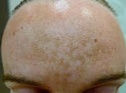 Image result for Melasma