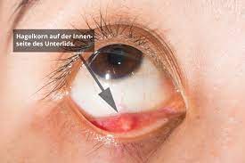Meist auch durch bedeutende größe von diesem ausgezeichnetes gerstenkorn (s.d., med. Hagelkorn Chalazion Ursachen Symptome Behandlung