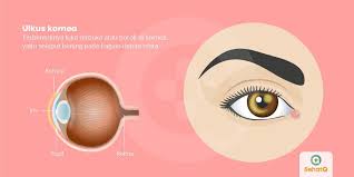 Maybe you would like to learn more about one of these? Ulkus Kornea Tanda Dan Gejala Penyebab Cara Mengobati Cara Mencegah