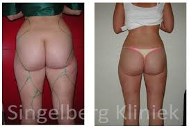 Liposuctie Liposculptuur Singelberg Kliniek