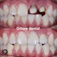 Tooth capping product image