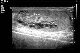 Tubular ectasia of the epididymis results in enlargement of the epididymis with multiple cystic interfaces. Tubular Ectasia Of Rete Testis Radiology Case Radiopaedia Org
