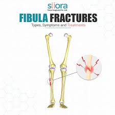 Image result for Fracture Type