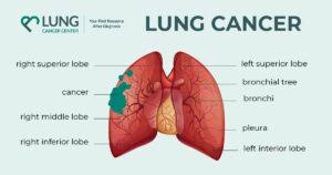 Image result for Lung Cancer