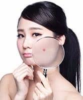 Laser Mole & Skin Tag Removal Singapore