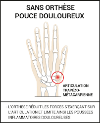 Les symptômes communs peuvent inclure une douleur localisée en dessous des côtes et sur le côté du torse. Orthese Sur Mesure Pouce Et Poignet Rhizarthrose Epitact