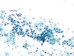In premenopausal women, the transformation zone is fully located on the ectocervix. Cytopathology Of The Uterine Cervix Digital Atlas