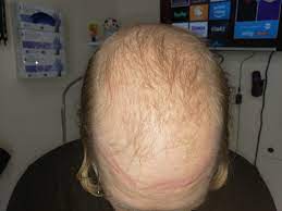 Stimulates hair growth by penetrating deep into the follicles. Results Of Two Months Of My New Hair Growth Compound On A Patient With A Previously Completely Bald Top Of The Head Drwillpowers