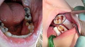 Gigi geraham atas kanan dengan kondisi periodontitis kronis,disini bisa ditandai dengan kondisi gigi nya sisa akar gigi diakibatkan karena gigi berlubang yang dibiarkan terus menerus sehingga. Ini Cara Mudah Memperbaiki Gigi Berlubang Dan Mengatasi Kerusakan Gigi Secara Alami Halaman All Sriwijaya Post