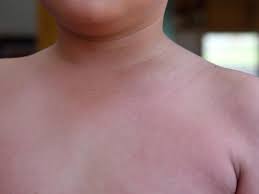 Scarlattina e bambini sono strettamente legati tra loro, per il fatto che i secondi rappresentano il target preferito della prima; Scarlattina Amico Pediatra