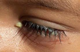 العيون الل ز قة إفرازات العين الأسباب والعلاجات