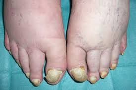 Image result for Yellow nail syndrome feet