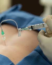 How Long Does It Take For Epidural Steroid Injections To Take Effect