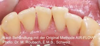 24 stunden als „bitzelnd bzw. Zahnarztpraxis Dr Klaus H Weber Aalen Curfessstr 9 Am Stadtgarten Prophylaxe