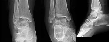 Image result for Ankle XRay