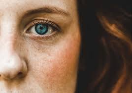 Image result for xantelasma