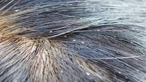 Image result for Lice