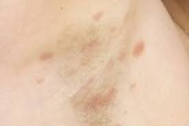 Image result for Erythrasma