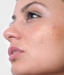 This breaks the blood vessels at the site, allowing blood and lymph fluids to if you can't stand that painful blister for another second, the best way to get immediate relief is to pop and drain your blood blister. Facial Veins Medicart