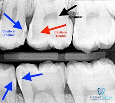 Cavity decayed tooth on wooden brown toothbrush on white background, how to prevent tooth decay and dentist, doctor examines oral cavity of small patient, length of frenum, boy, kid performs. What Is A Flossing Cavity And How Can I Prevent It Caring Smiles Family Dentistry West Bloomfield Dentist Dentist General Dentist