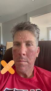 Day 6 post Deep Chemical Acid Peel. Swelling feeling is still pretty bad.  Feels more intense in the morning. I also feel like I can’t possibly  consume enough water. For those of you see me drink and ...