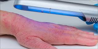 Image result for Phototherapy