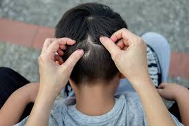 Psoriasis can affect your scalp, and the red, scaly patches it causes can flake off like dandruff does. Best Dandruff Shampoo For Kids 2021 Reviews And Buying Guide