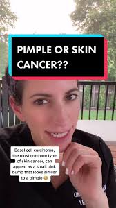 #basalcellcarcinoma #skincancer #pimple #spf #sunprotection #docsoftiktok  #dermatologist