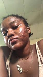 what causes this unappetizing skin sooty mess?