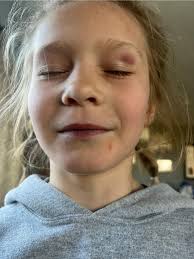 Little Missy got her first black eye from wrestling over the weekend and  she's still smiling!! BUILT 💪❤️