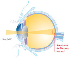 Grauer Star Behandeln Lassen