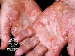 Image result for psoriasis