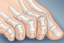 What Your Feet Say About Your Health Foot Remedies Claw Toe Swollen Feet Remedy