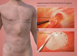 These hernias are located between the belly button or navel, and the lower part of the breast bone. Ventral Hernia Repair Pasadena Orange County Ca