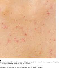The cause of spider naevi can be related to physical trauma in the area, hormonal influences, pregnancy, the contraception pill and lifestyle and hereditary. Cirrhosis And Its Complications Anesthesia Key